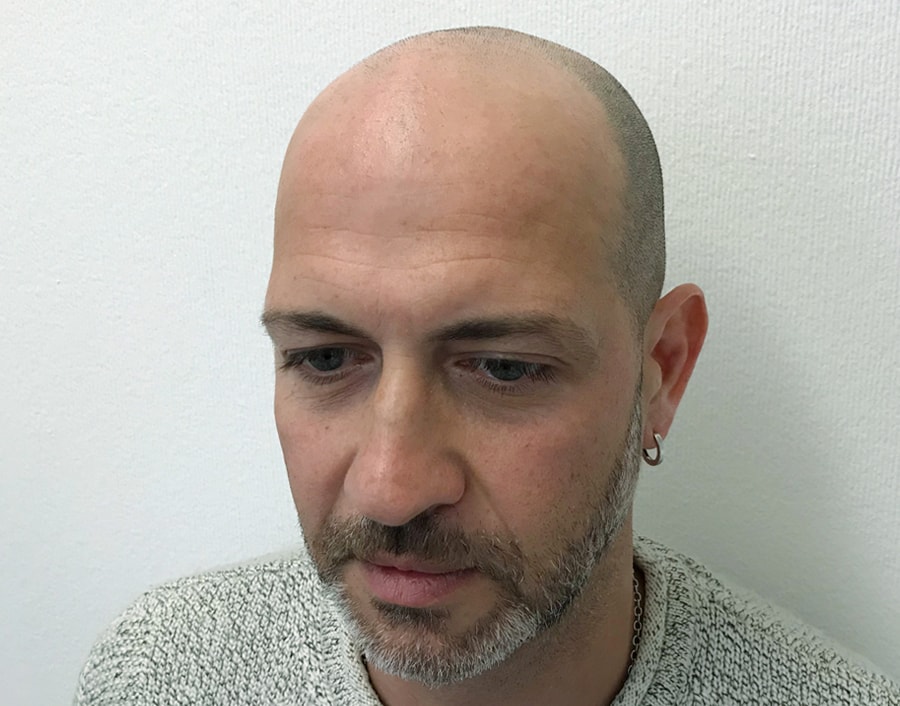 Antonio Before Scalp Micropigmentation 2