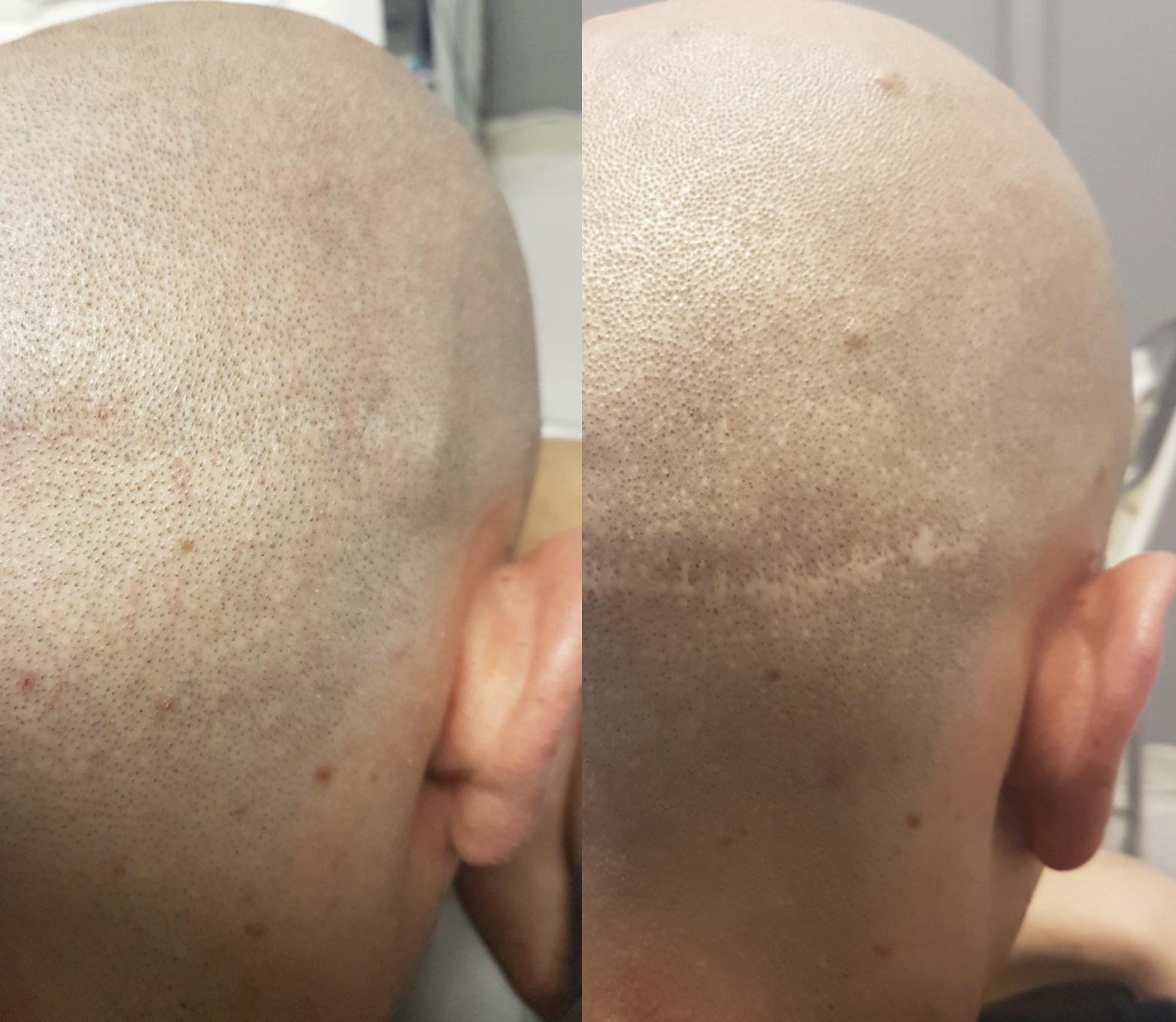 HT Scars Scalp Micropigmentation can fix