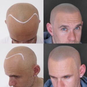 SCALP MICROPIGMENTATION