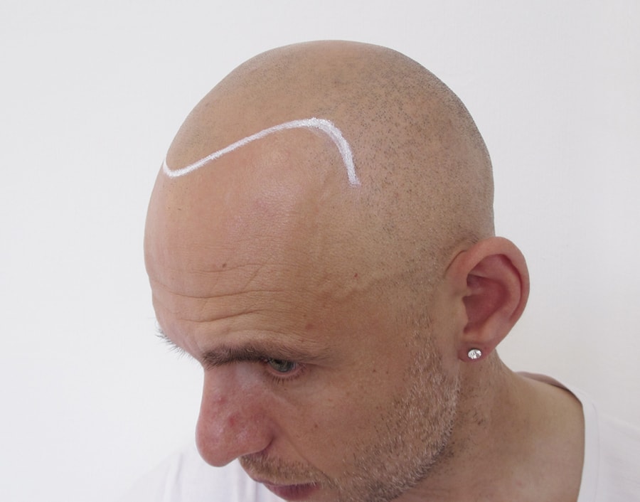 Gerbeshi Before Scalp Micropigmentation 2