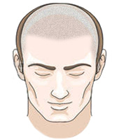 Male Hair Loss Scalp Micropigmentation Cost