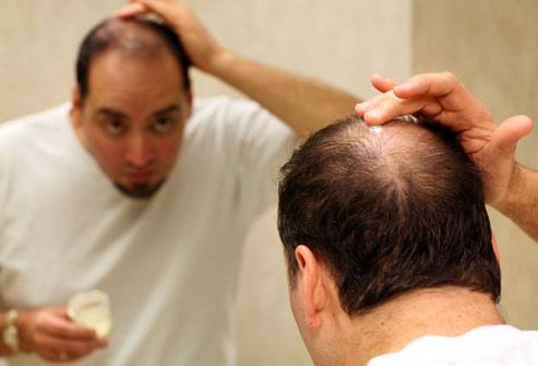 webmd_rf_photo_of_man_applying_minoxidil