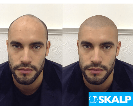 Adam body shockers hairline mock-up