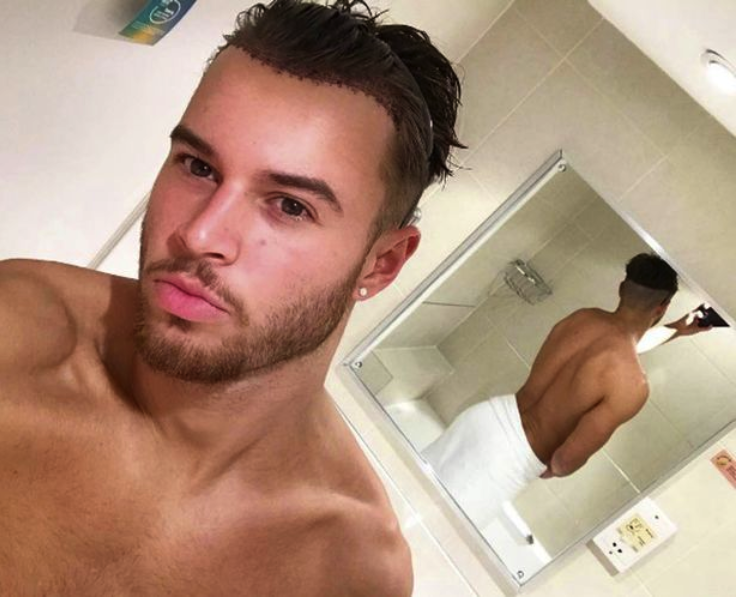 Alex Beattie from Love Island revealed celebrity hair transplant for receeding hairline