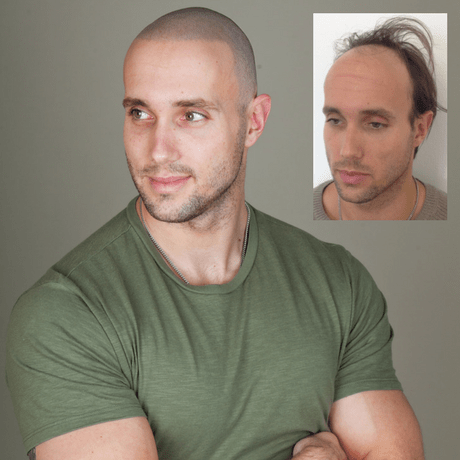 bald men turn to scalp micro pigmentation to regain confidence