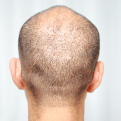 can collagen supplements help with hair loss