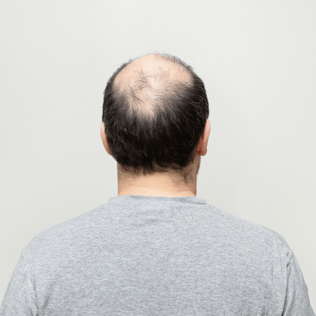 new drug breakthrough cure for male pattern baldness Cyclosporine A for hair loss