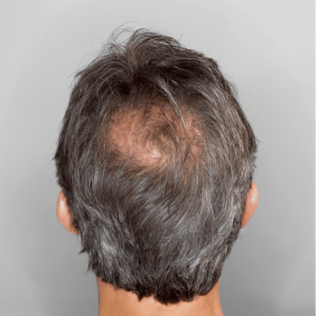 man-with-baldness-cure