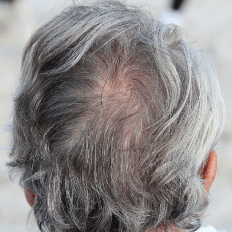 hair thinning