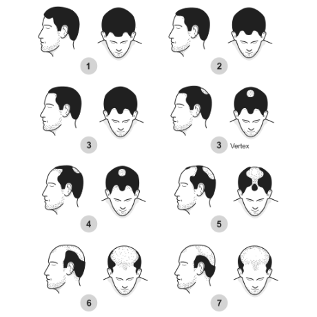 Norwood Hamilton Hair Loss Scale