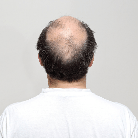 scalp micropigmentation for male pattern baldness