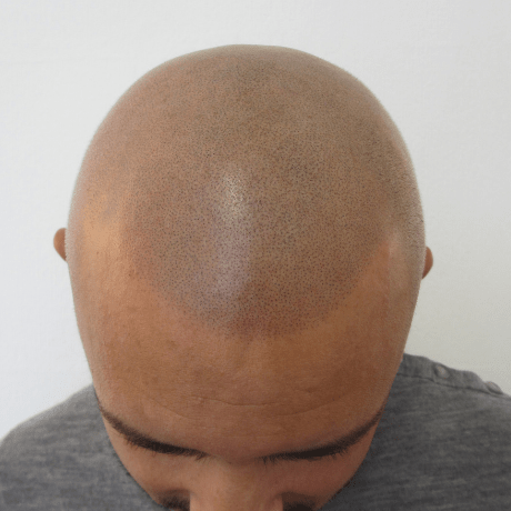 Hair loss tattoo