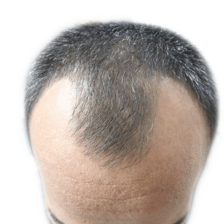 Male Pattern Baldness