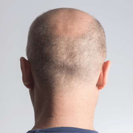 back of bald mans head- Ways To Know If You Are Going Bald