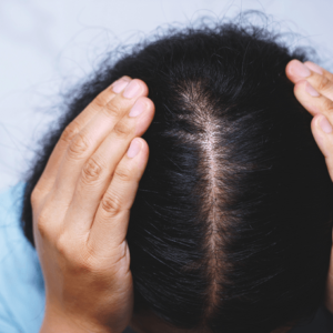 woman with hair loss