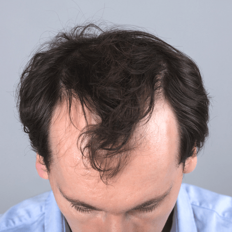 young man with a receding hairline